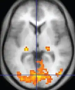 fMRI image showing the brain from a top view with active areas colored in orange