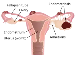 Diagram of uterus with endometriosis on Fallopian tubes and an endometrioma in the right ovary. Adhesions connect the right ovary to the uterus.