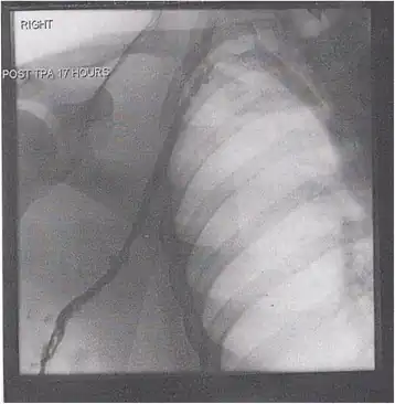 After treatment with catheter-directed thrombolysis, blood flow in the axillary and subclavian vein was significantly improved. Afterwards, a first rib resection allowed decompression. This reduces the risk of recurrent DVT and other sequelae from thoracic outlet compression.[147]