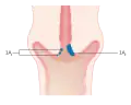 Stage 1A cervical cancer