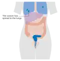 Stage 4B cervical cancer
