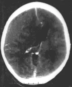 Nontraumatic epidural hematoma in a young woman. The grey area in the top right is organizing hematoma, causing midline shift and compression of the ventricle.