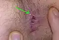 Fissurectomy wound 3.5 weeks after the OP