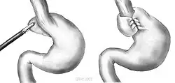 Image of a stomach which has undergone Fundoplomy, where the Fundus, the upper part of the stomach (similar to the top part of a kidneybean) is wrapped around the attached esophagus and sewn back to the itself