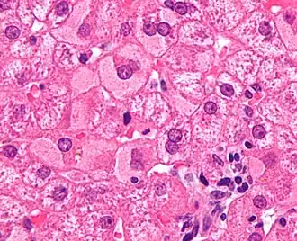 Ground glass hepatocytes