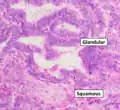 Grade 1: ≤5% solid non-glandular, non-squamous growth.[63]
