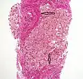 Histopathology of steatohepatitis with established cirrhosis, with thick bands of fibrosis (Van Gieson's stain)[96]