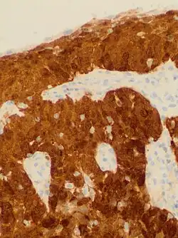 Cervical squamous cell carcinoma generally shows diffuse staining of both nuclei and cytoplasm on p16 immuno- histochemistry (except verrucous variant).[75]