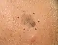 Melanoma, vertex scalp marked for biopsy