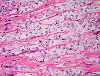 Poorly differentiated, where attempts at keratinization are often no longer evident. This is a clear-cell squamous-cell carcinoma. The dysplastic cells infiltrated cords through the dermis. Poorly differentiated cSCC has greatly enlarged pleomorphic nuclei showing a&nbsp;high degree of atypia and frequent mitoses.[12]
