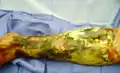 Necrotizing fasciitis type III caused by Vibrio vulnificus.