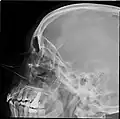 Paranasal sinuses radiograph (lateral)