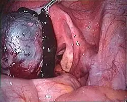 A silvery-brown cyst with a dark viscous fluid leaking out
