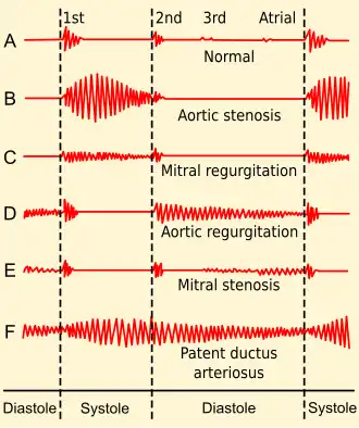 Phonocardiograms from normal and abnormal heart sounds