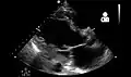 Ultrasound showing severe systolic heart failure[74]