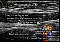 Ultrasound of a normal appendix for comparison.
